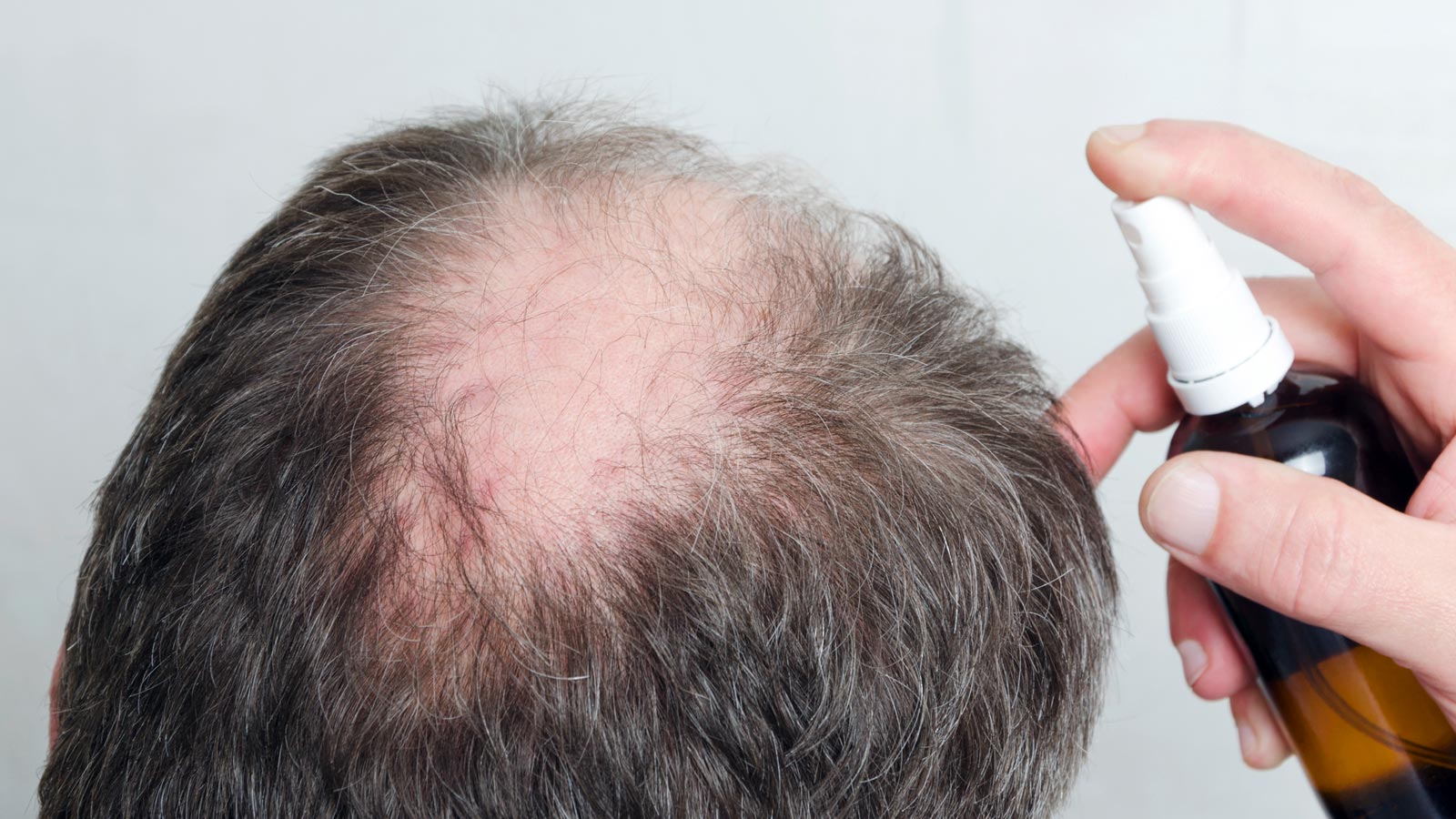 Calvicie cosméticos